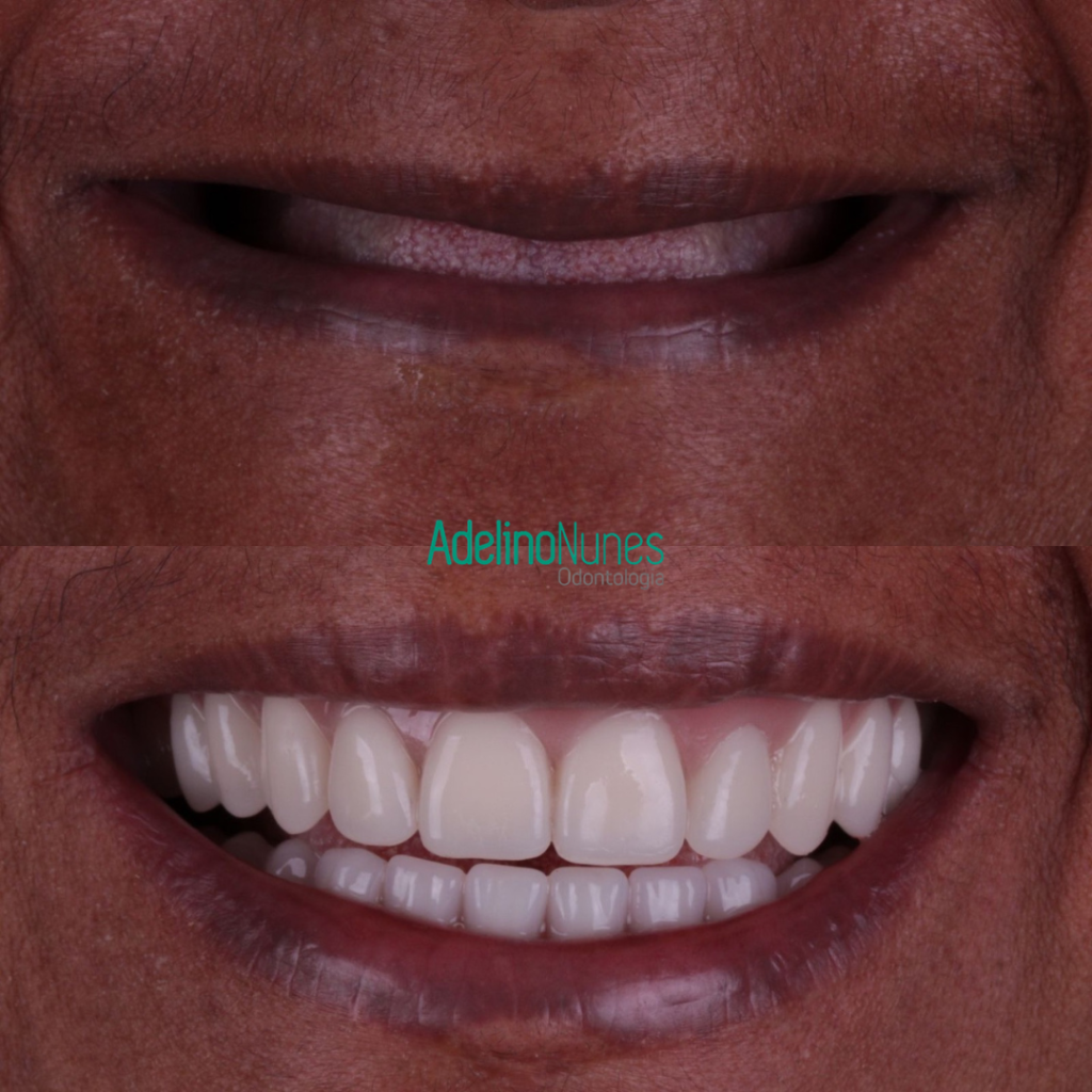 Adelino Nunes Odontologia - dentista-implante dentário em teresina